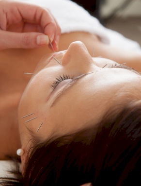 Acupuncture Face Lift